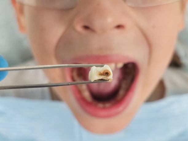 Best Emergency Treatment for Dental Infections or Abscesses in Saticoy, CA